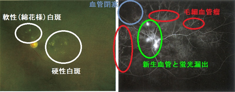 糖尿病網膜症、眼底写真、フルオレセイン蛍光眼底造影検査 糖尿病網膜症、眼底写真、フルオレセイン蛍光眼底造影検査