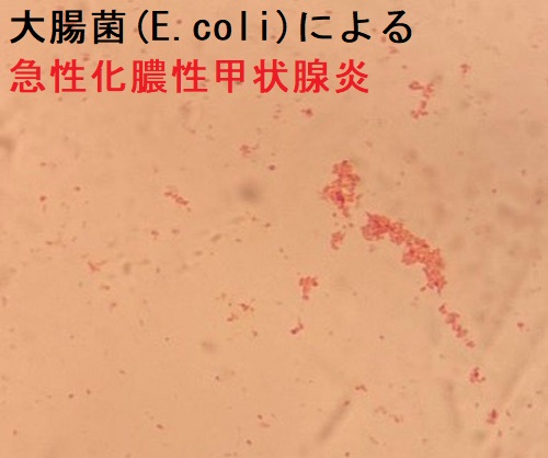 大腸菌(E.coli)が原因の急性化膿性甲状腺炎 大腸菌(E.coli)が原因の急性化膿性甲状腺炎