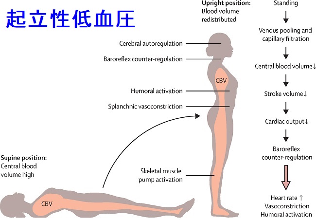 起立性低血圧 起立性低血圧