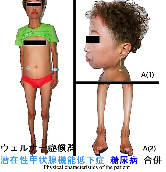 ウェルナー症候群 潜在性甲状腺機能低下症 糖尿病 ウェルナー症候群 潜在性甲状腺機能低下症 糖尿病