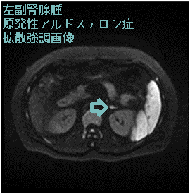 左副腎腺腫 原発性アルドステロン症 MRI 拡散強調画像 左副腎腺腫 原発性アルドステロン症 MRI 拡散強調画像