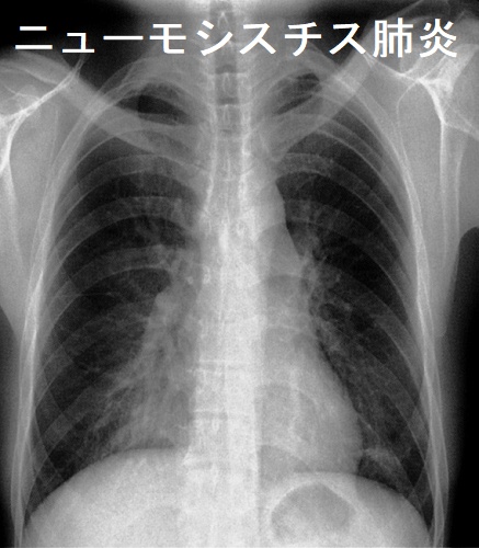 ニューモシスチス肺炎 胸部エックス線写真 ニューモシスチス肺炎 胸部エックス線写真