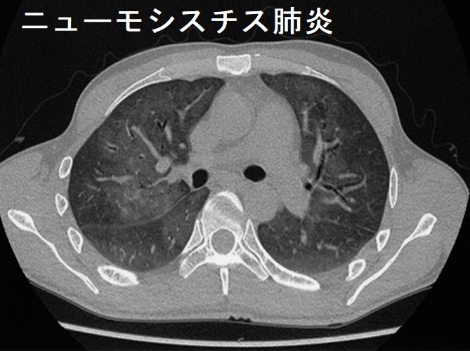 ニューモシスチス肺炎 胸部CT写真 ニューモシスチス肺炎 胸部CT写真