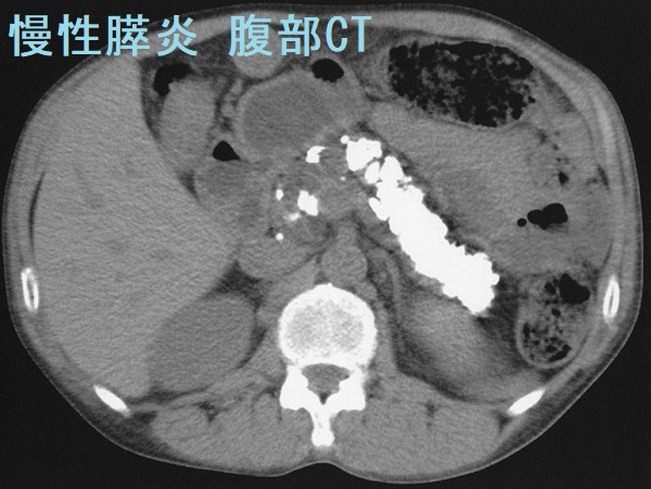 【超希少石】膵結石　超希少な膵結石　膵石　スイセキ　人体石標本資料 超希少石】膵結石 超希少な膵結石 膵石 スイセキ 人体石標本資料