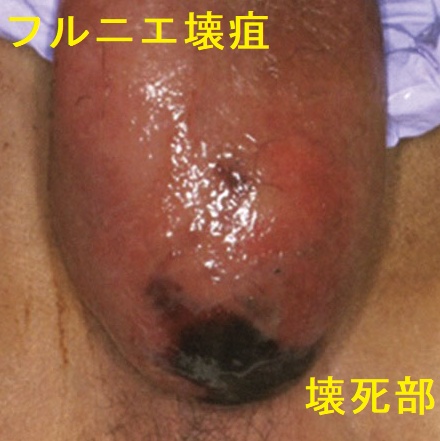 壊死性筋膜炎(フルニエ壊疽) 壊死性筋膜炎(フルニエ壊疽)