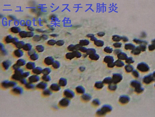 ニューモシスチス肺炎 気管支肺胞洗浄液Grocott染色 ニューモシスチス肺炎 気管支肺胞洗浄液Grocott染色