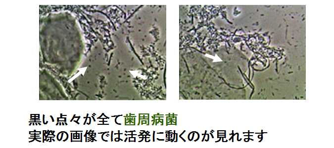 歯周病菌 歯周病菌