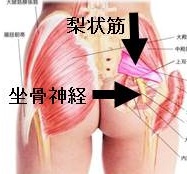 閉塞性動脈硬化症と鑑別を要する梨状筋症候群 閉塞性動脈硬化症と鑑別を要する梨状筋症候群