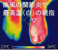 痛風 痛風