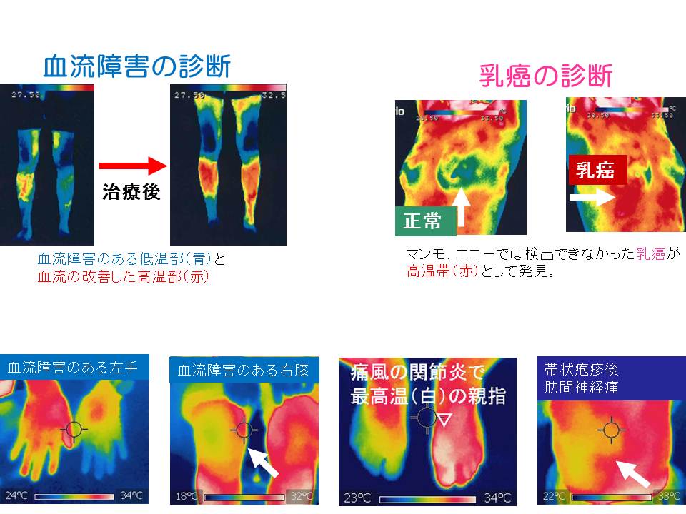 サーモグラフィー検査 サーモグラフィー検査