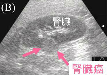 腎臓がん 超音波エコー画像 腎臓がん 超音波エコー画像