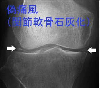偽痛風 軟骨石灰化 偽痛風 軟骨石灰化