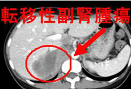 転移性副腎腫瘍 造影CT像 転移性副腎腫瘍 造影CT像
