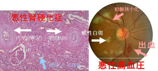 悪性高血圧,悪性腎硬化症 悪性高血圧,悪性腎硬化症