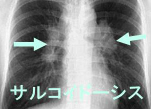 肺サルコイドーシス 肺サルコイドーシス