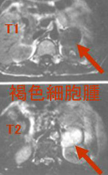 副腎腫瘍(褐色細胞腫) MRI画像 副腎腫瘍(褐色細胞腫) MRI画像