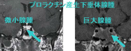プロラクチン産生性下垂体腺腫(プロラクチノーマ)MRI画像 プロラクチン産生性下垂体腺腫(プロラクチノーマ)MRI画像