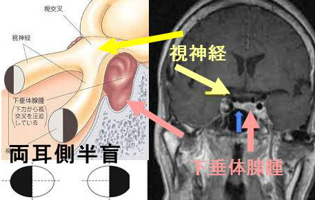 下垂体腫瘍と視野欠損(両耳側半盲) 下垂体腫瘍と視野欠損(両耳側半盲)