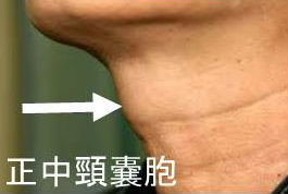 正中頸のう胞(甲状舌管嚢胞) 正中頸のう胞(甲状舌管嚢胞)
