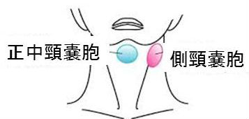 正中頸のう胞(甲状舌管嚢胞) 正中頸のう胞(甲状舌管嚢胞)