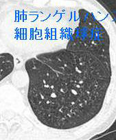 肺ランゲルハンス細胞組織球症(肺好酸球性肉芽腫症) 肺ランゲルハンス細胞組織球症(肺好酸球性肉芽腫症)