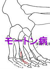 モートン病 モートン病