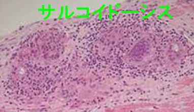 サルコイドーシスでも高カルシウム血症 サルコイドーシスでも高カルシウム血症