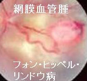 もう一つの遺伝性褐色細胞腫Von Hippel-Lindau(フォン・ヒッペル・リンドウ、VHL)病 もう一つの遺伝性褐色細胞腫Von Hippel-Lindau(フォン・ヒッペル・リンドウ、VHL)病