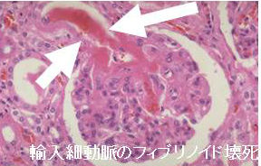 悪性高血圧・悪性腎硬化症 悪性高血圧・悪性腎硬化症