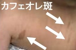 マッキューン・オルブライト(McCune-Albright)症候群 マッキューン・オルブライト(McCune-Albright)症候群