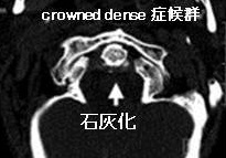 クラウンド デンス症候群(crowned dense 症候群) クラウンド デンス症候群(crowned dense 症候群)