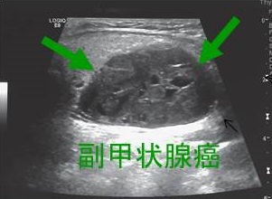 副甲状腺癌 超音波(エコー)画像 副甲状腺癌 超音波(エコー)画像