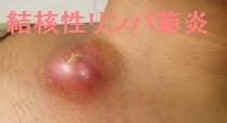 結核性リンパ節炎 皮膚の発赤 結核性リンパ節炎 皮膚の発赤