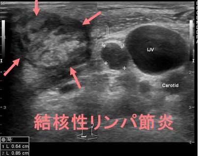 結核性リンパ節炎 超音波(エコー)画像 結核性リンパ節炎 超音波(エコー)画像