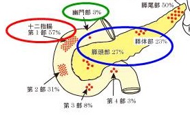 ガストリン産生腫瘍(ガストリノーマ)の好発部位 ガストリン産生腫瘍(ガストリノーマ)の好発部位