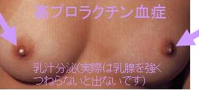 プロラクチン産生腺腫(プロラクチノーマ)の乳汁分泌 プロラクチン産生腺腫(プロラクチノーマ)の乳汁分泌