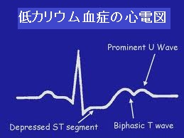 低カリウム血症の心電図 低カリウム血症の心電図