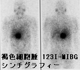 褐色細胞腫 123I-MIBG(メタヨードベンジルグアニジン)シンチグラフィー 褐色細胞腫 123I-MIBG(メタヨードベンジルグアニジン)シンチグラフィー
