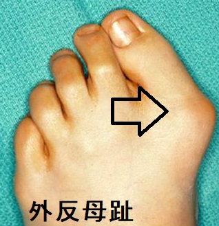 外反母趾 外反母趾