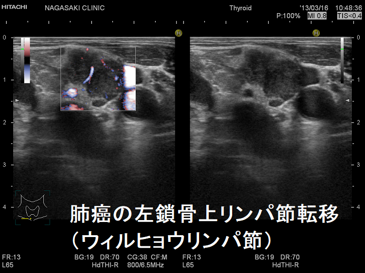 肺癌の左鎖骨上リンパ節転移(ウィルヒョウリンパ節) 肺癌の左鎖骨上リンパ節転移(ウィルヒョウリンパ節)