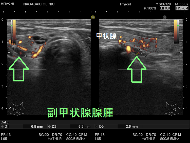 副甲状腺腺腫 超音波(エコー)画像 副甲状腺腺腫 超音波(エコー)画像