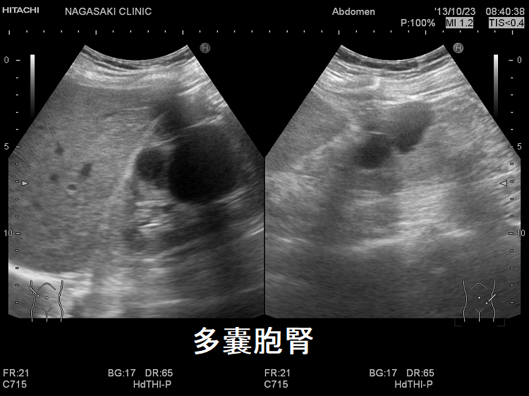 多発性嚢胞腎(ADPKD) 超音波エコー画像 多発性嚢胞腎(ADPKD) 超音波エコー画像