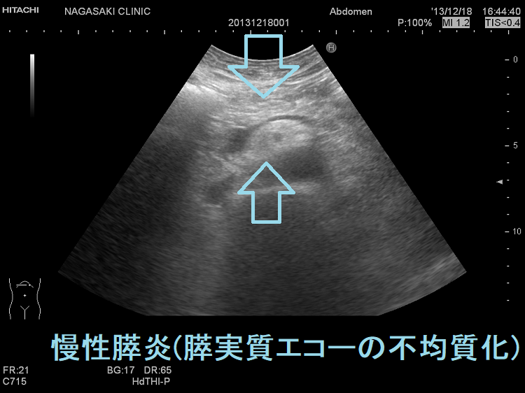 慢性膵炎 超音波(エコー)画像 慢性膵炎 超音波(エコー)画像