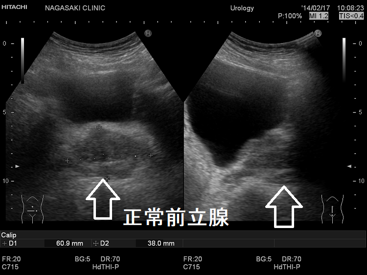 正常前立腺 超音波(エコー)画像 正常前立腺 超音波(エコー)画像