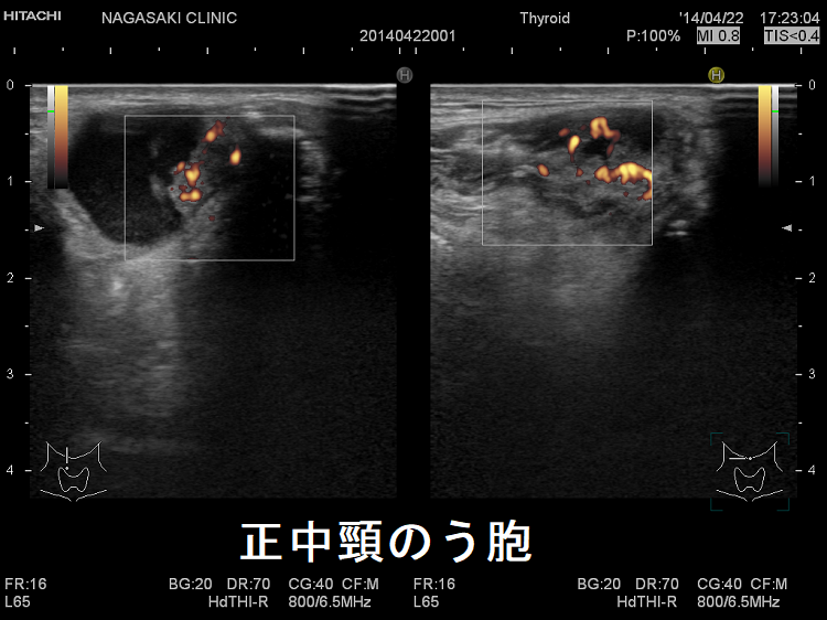正中頸のう胞 超音波(エコー)画像 ドプラー 正中頸のう胞 超音波(エコー)画像 ドプラー