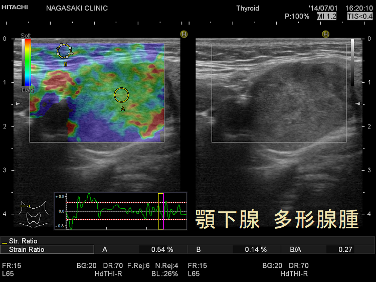 顎下腺 多形腺腫 超音波(エコー)画像 エラストグラフィー 顎下腺 多形腺腫 超音波(エコー)画像 エラストグラフィー