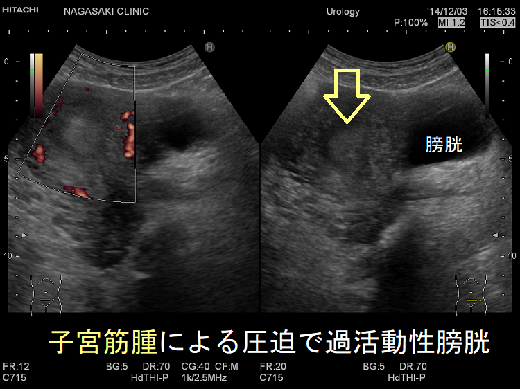 子宮筋腫による圧迫で過活動性膀胱 超音波(エコー)画像 子宮筋腫による圧迫で過活動性膀胱 超音波(エコー)画像