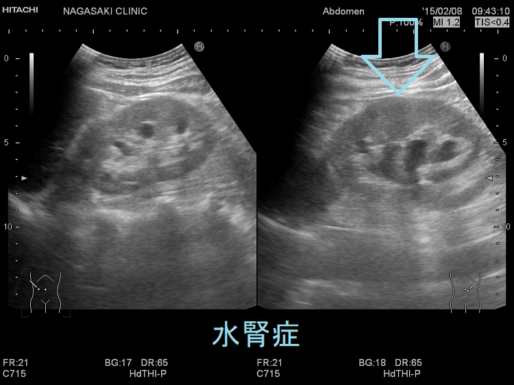 水腎症 超音波(エコー)画像 水腎症 超音波(エコー)画像