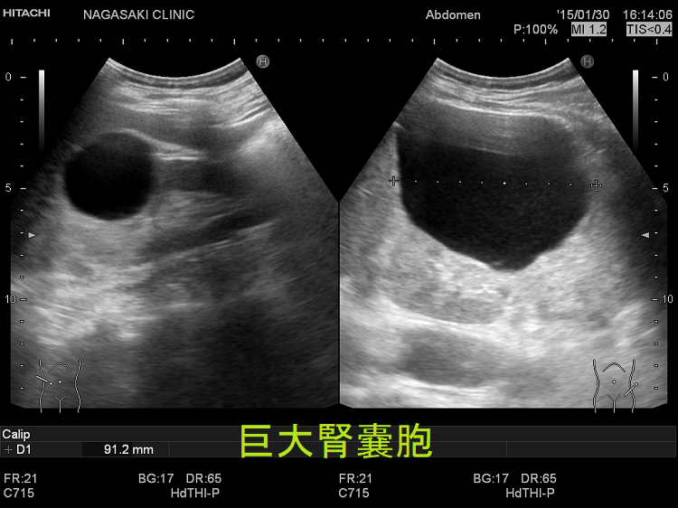 巨大腎嚢胞 巨大腎嚢胞
