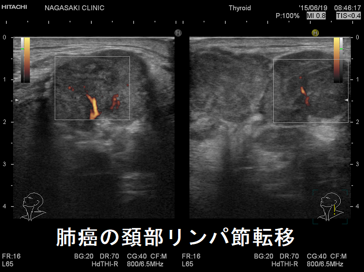 肺癌の頚部リンパ節転移 超音波(エコー)画像 肺癌の頚部リンパ節転移 超音波(エコー)画像